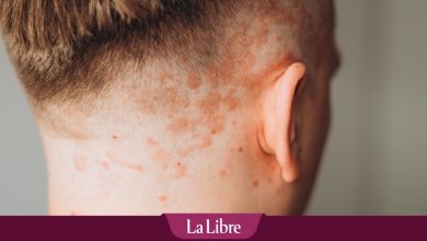 Pour les patients atteints de psoriasis, les problèmes vont bien au-delà des plaques rouges sur la peau