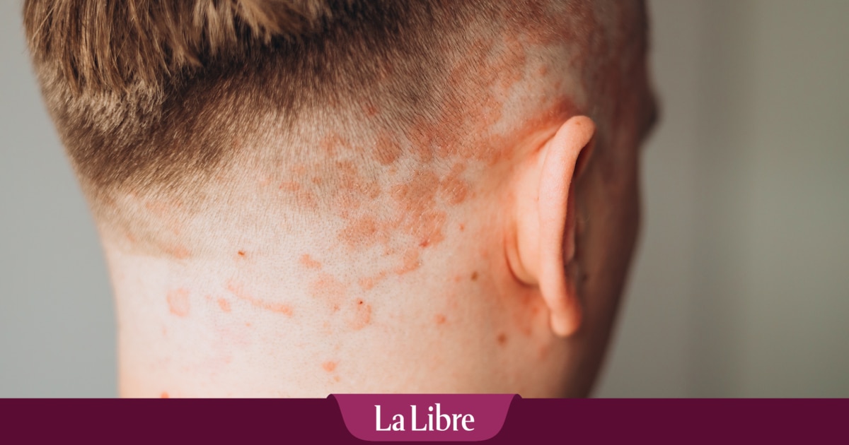 Pour les patients atteints de psoriasis, les problèmes vont bien au-delà des plaques rouges sur la peau