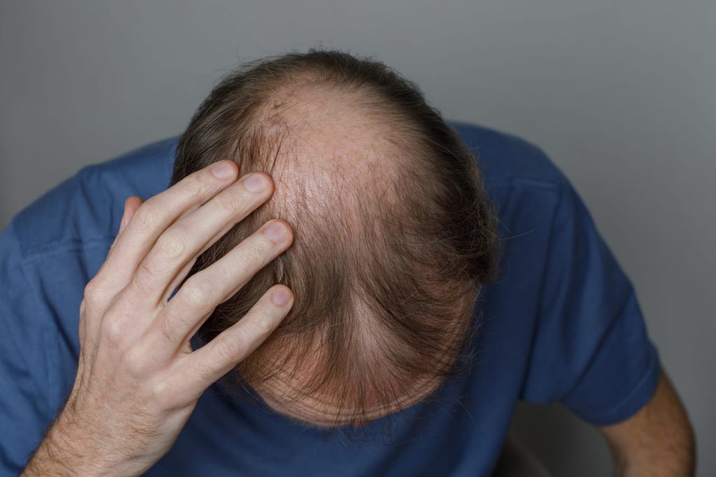 Ce traitement contre la perte de cheveux chez les hommes fonctionne mieux que les autres